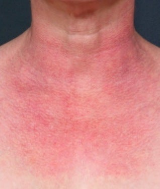 Vbeam (PDL) for chest before 374526