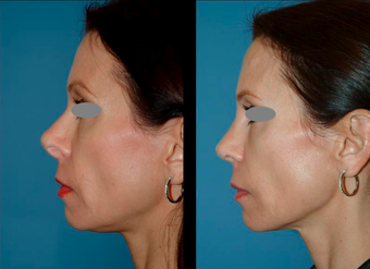Revision Rhinoplasty (open) after 306788