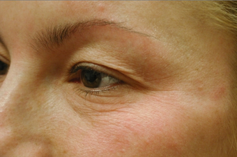 Laser eyelift before 129023
