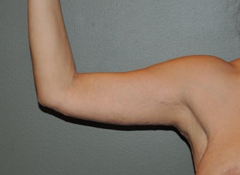 Arm Lift 530722