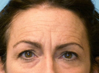 Forehead Lift before 581211