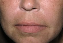 Juvederm after 336245