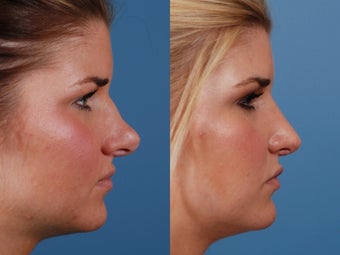 Revision rhinoplasty after 395562