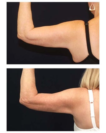 Liposuction before 286787