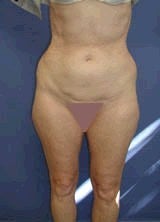 Liposculpture, Liposuction Surgery before 151078