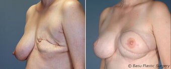 Breast reconstruction before 270818