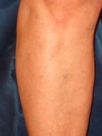 Sclerotherapy on Leg after 370427