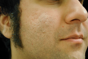 CO2 Affirm - Acne Scars after 200609