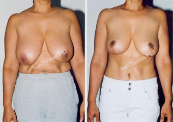 Tummy Tuck and Breast Reduction before 247326