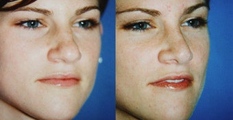 Rhinoplasty before 633431