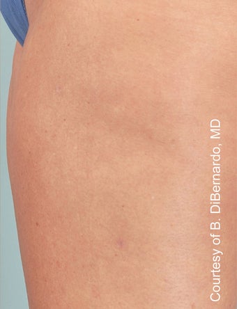 Smart Lipo after 606715