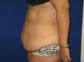 Abdominoplasty before 228292