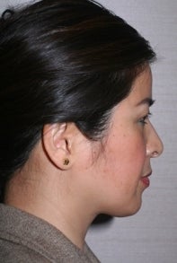 Asian Rhinoplasty before 448671