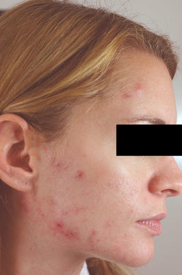 Laser Acne Treatment before 82977
