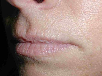 Restylane in Upper Lip before 108822