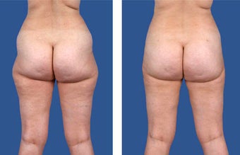 Liposuction before 253575