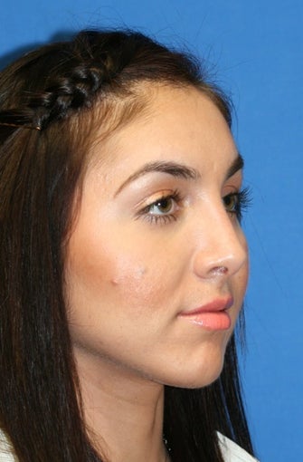 Rhinoplasty after 223234