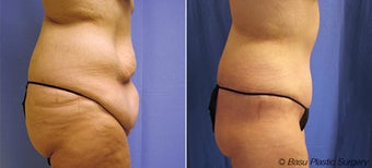 Body Lift before 270847