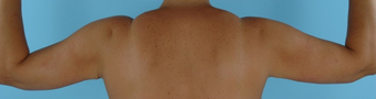 Arm Lift after 230666