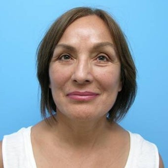 Face and Neck Lift with Bilateral Lower Eyelid Skin Excision and an Autologous Fat Transfer to the Face after 551915