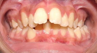 Teen Orthodontic Treatment (case #1DC) before 224713