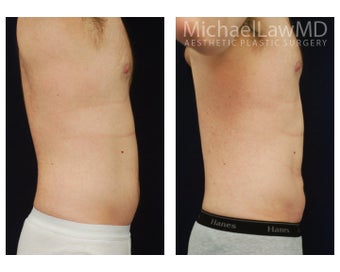 Liposuction 392463