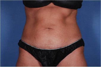 Liposonix to Abdomen before 448753