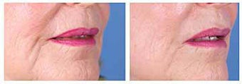 Restylane for nasolabial folds and marionette lines before 6267