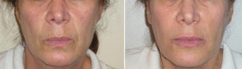 Lower Face Filler before 185801
