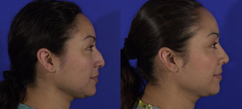 Rhinoplasty before 257759