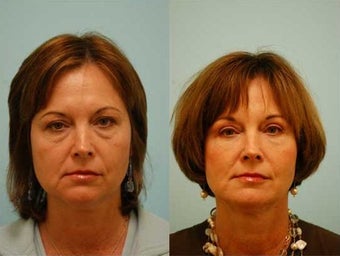 Fat Transfer/Fat Grafting/Facial Rejuvenation before 136338
