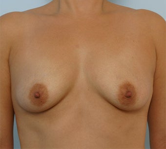 Breast Augmentation before 260940