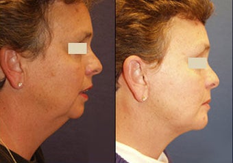 Chin Augmentation before 97278