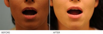 Upper Lip Reduction for Traumatic Lip Deformity after 391530