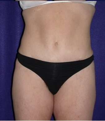Tummy Tuck (abdominoplasty) after 208482