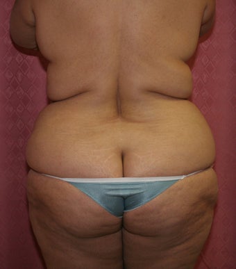 liposuction of abdomen and flanks 582260