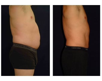 Liposuction before 286839