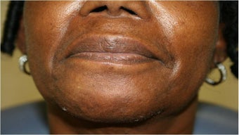 Lip augmentation with Juvederm before 302912