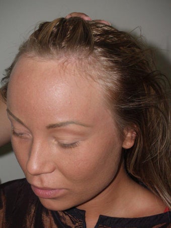 Surgical Hairline Advancement Procedure 535779