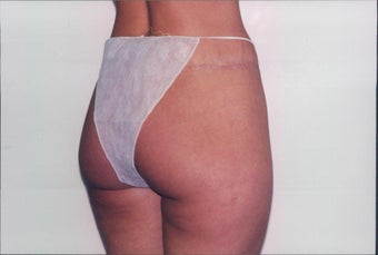 Body Lift after 217907