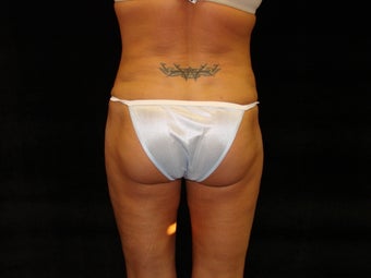 Liposuction of Abdomen, Waist, Flanks, and Inner/Outer Thighs after 203478