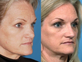 Revision rhinoplasty 334265