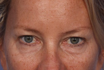 Restylane to Tear Trough (under eyes) before 308308