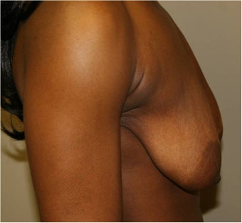 Mastopexy (Breast Lift) before 110540