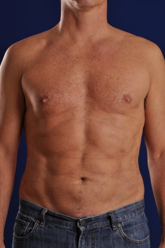 Vaser Hi Def Liposuction after 248823