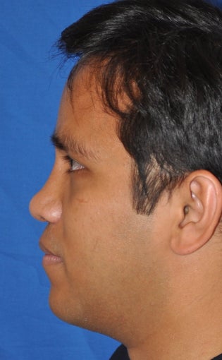 Rhinoplasty-Asian 370618