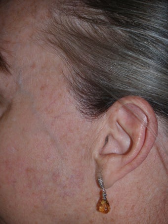 Reconstruction of sideburns with hair transplants lost as a result of prior facelift after 173883