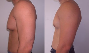 Gynecomastia 341117