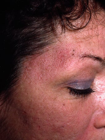 Acne Scarring after 417395