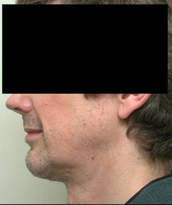 Neck Lift and Chin Implant after 106455